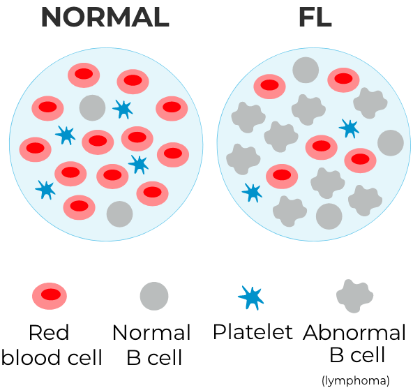 Normal cells vs FL cancer cells
