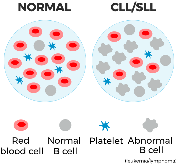 Normal cells vs CLL/SLL cancer cells